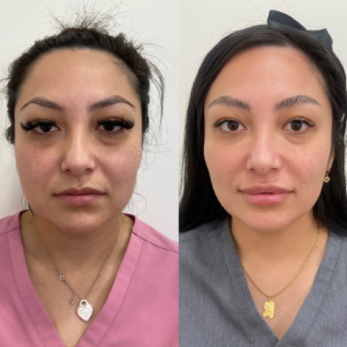 Inyección de PRP para la cara. Foto antes/después